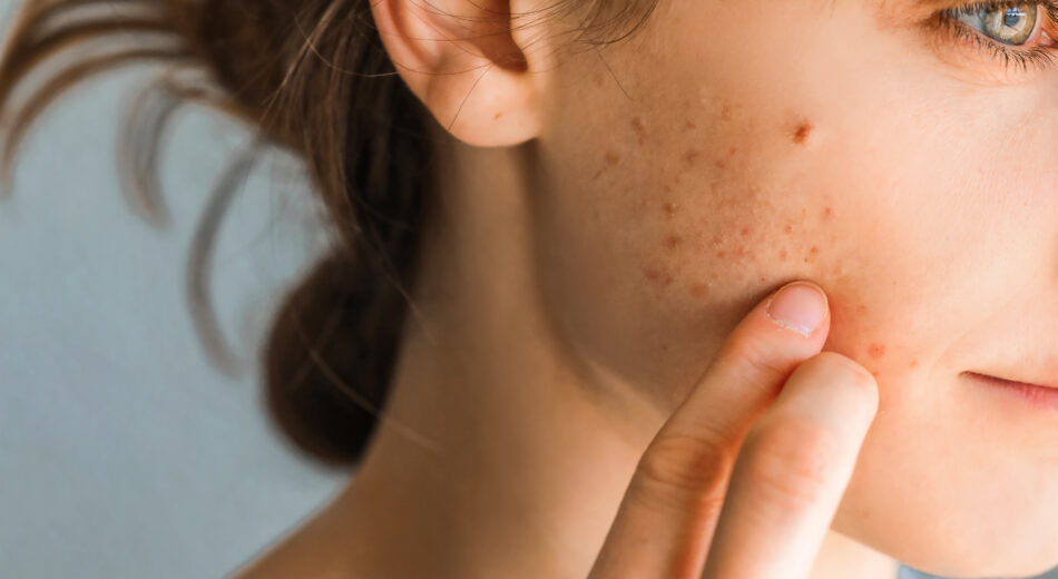 Frau mit Pickel im Gesicht